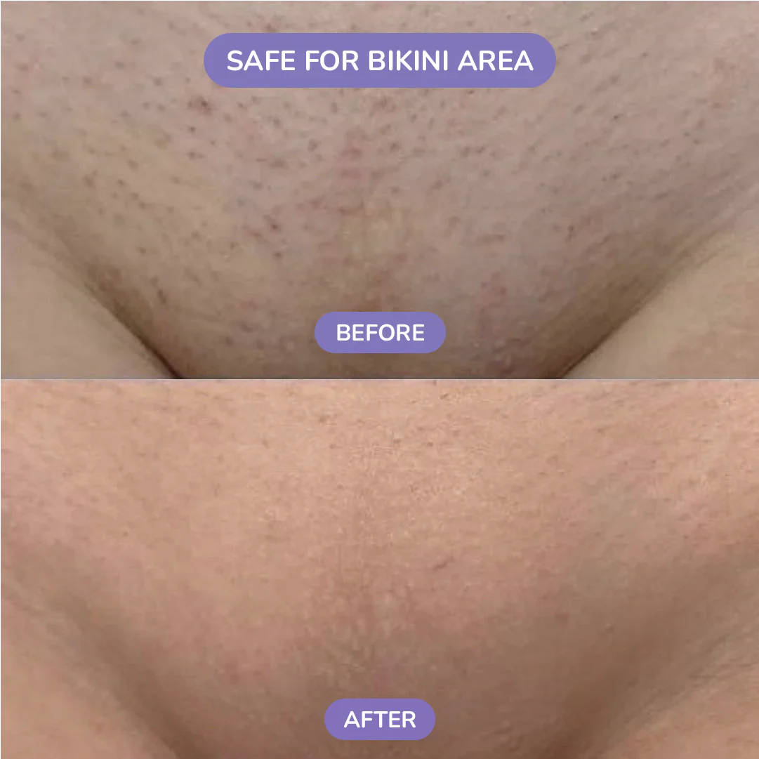 SilkStone™ Crystal Hair Eraser Stone